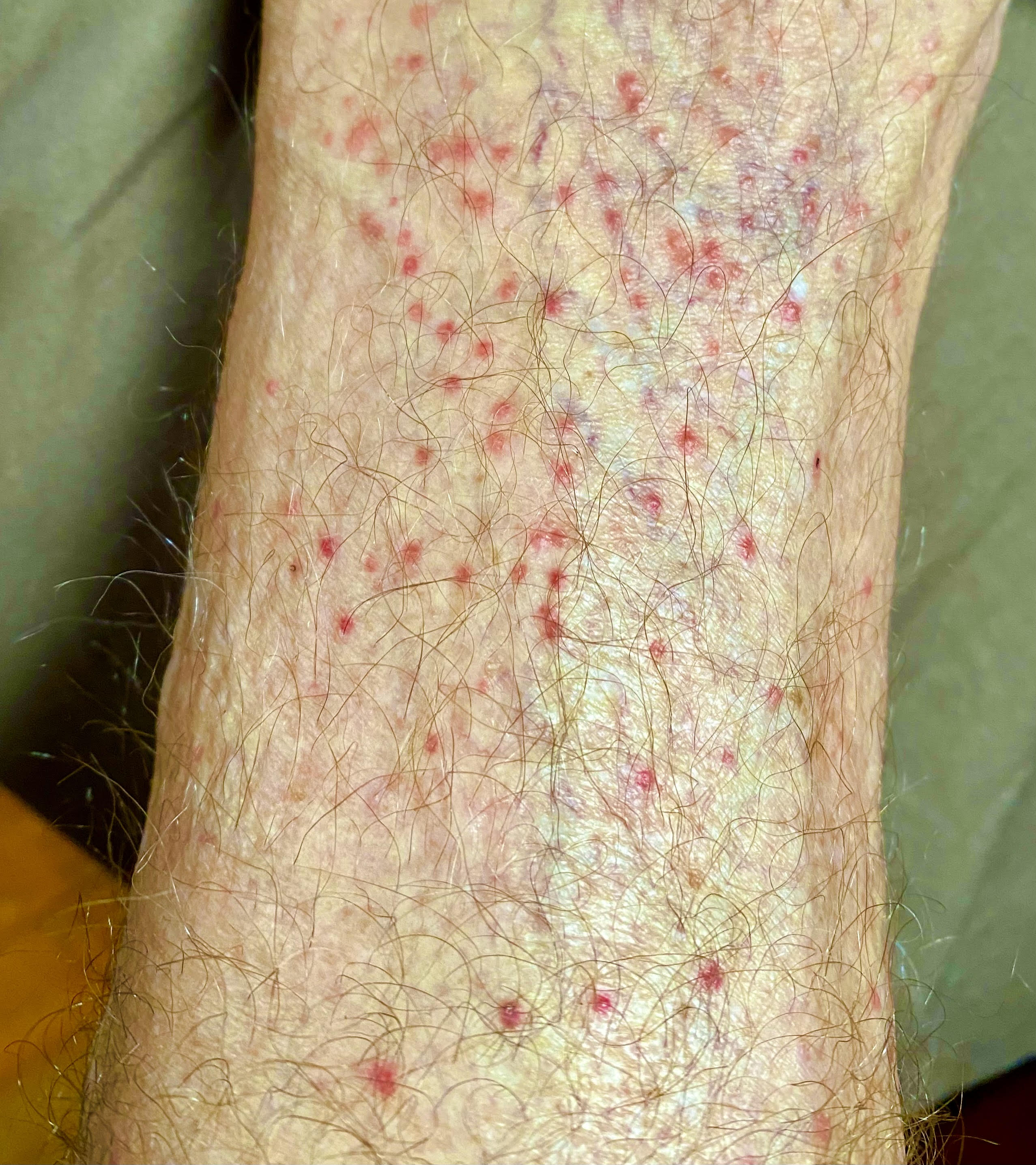 Chiggers Historic Union County